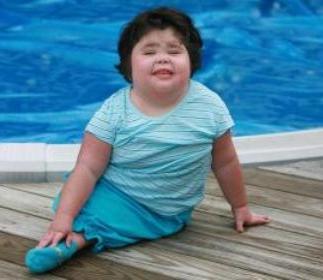 Mermaid Syndrome